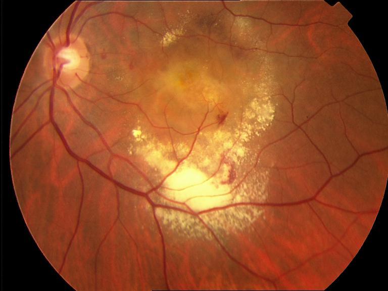 Imagen Degeneración macular asociada a la edad (DMAE)